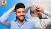 چگونه موهای کاشته شده را تقویت کنیم