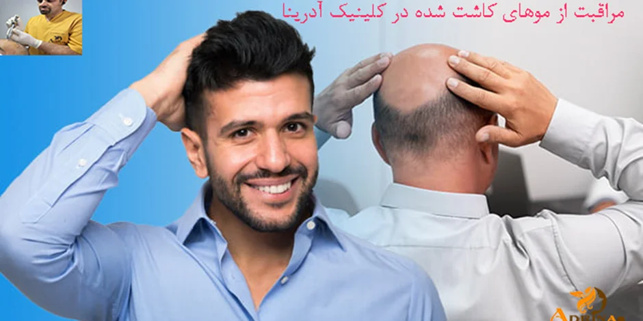 چگونه موهای کاشته شده را تقویت کنیم