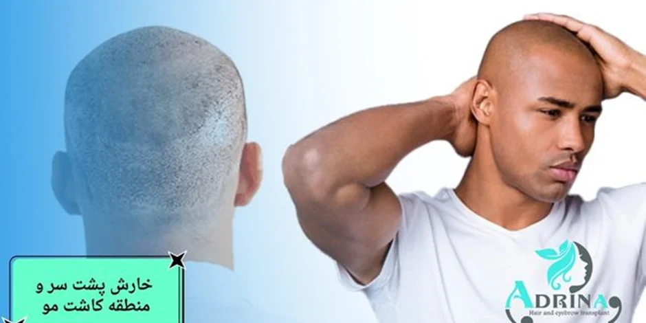 خارش و قرمزی پس از کاشت مو علت و نحوه درمان