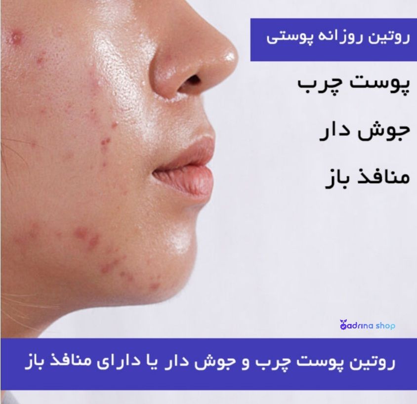 مهم ترین نکات طلایی برای شستن صورت جوش دار