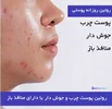 مهم ترین نکات طلایی برای شستن صورت جوش دار